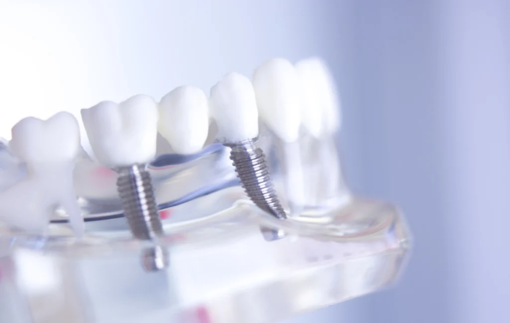 bridge implant mulhouse Implants dentaires Chirurgiens-dentistes à Mulhouse