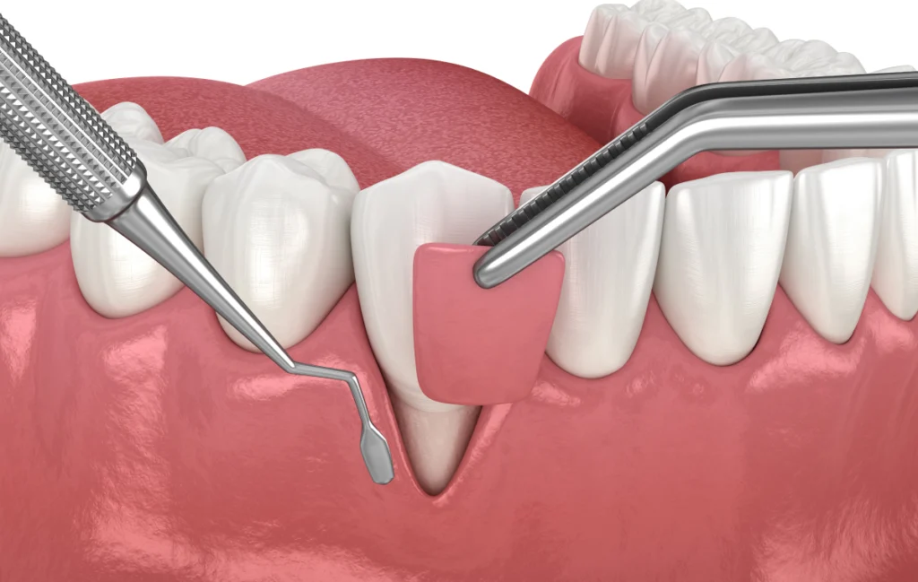 greffe gingivale mulhouse dentiste mulhouse greffe gingivale mulhouse dentiste mulhouse Soins des gencives Chirurgiens-dentistes à Mulhouse