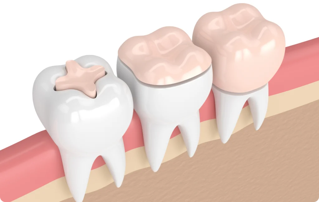 ilnay onlay mulhouse chirurgien dentiste ilnay onlay mulhouse chirurgien dentiste Omnipratique Chirurgiens-dentistes à Mulhouse